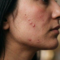 Acne & Breakouts