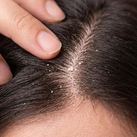 Dandruff & Scalp